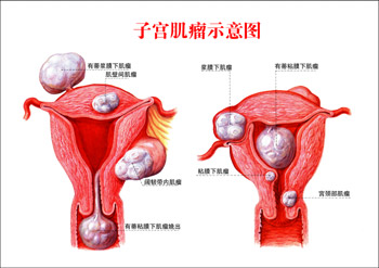 子宫肌瘤引起女性不孕