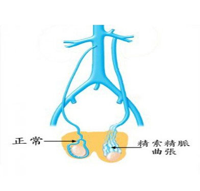 精索静脉曲张症状
