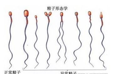 男性弱精症如何判断