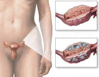 女性卵巢囊肿对生育的影响主要体现在哪些方面？
