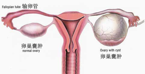 什么引起卵巢囊肿