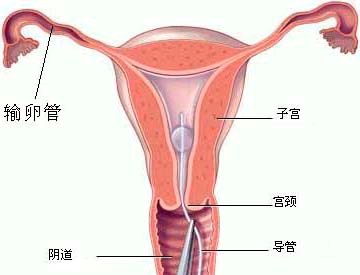 输卵管间质部堵塞