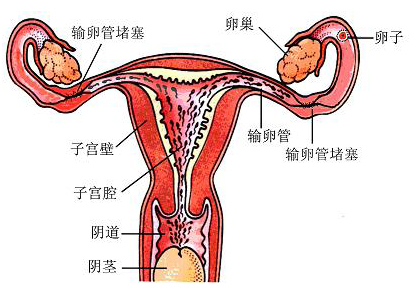 输卵管不通原因