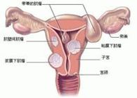 子宫肌瘤症状