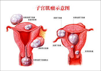 患子宫肌瘤的人群