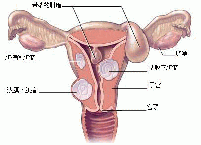 造成子宫肌瘤的原因是什么？