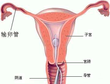 子宫内膜增厚