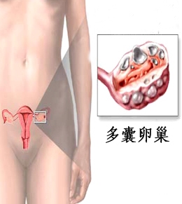 怎样自我检查多囊卵巢综合征?