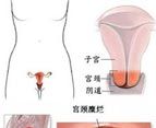 宫颈糜烂的症状